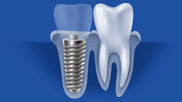 Zirconia Dental Implants vs Titanium: What's The Difference?